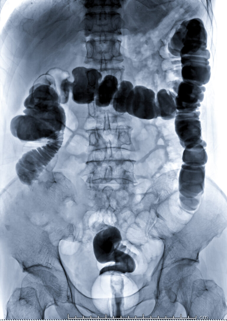 Barium Enema Image Or X-ray Image Of Large Intestine Showing An ...